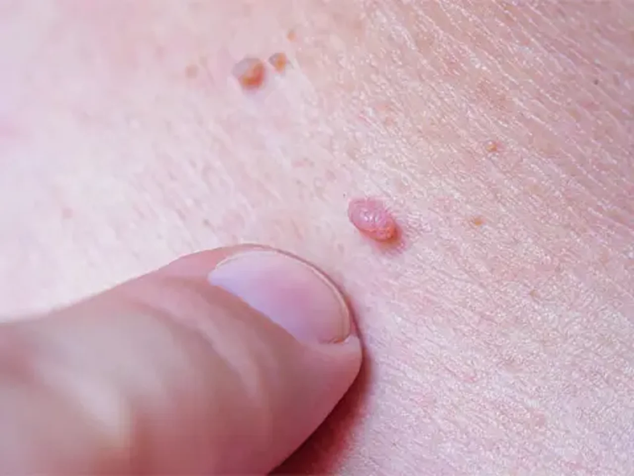 ویروسHpv و انواع زگیل تناسلی چیست ؟